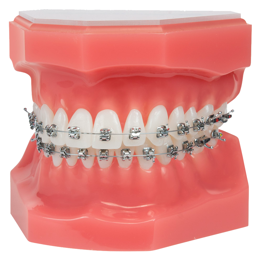 Исправление прикуса